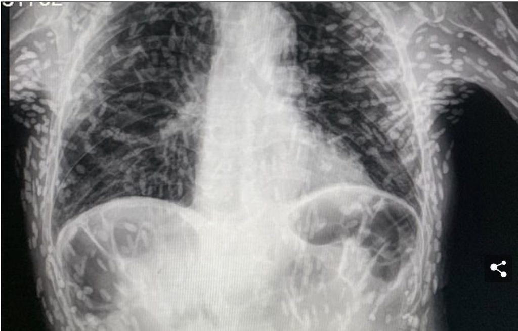 Doktoren schrikken zich rot door röntgenfoto van patiënt